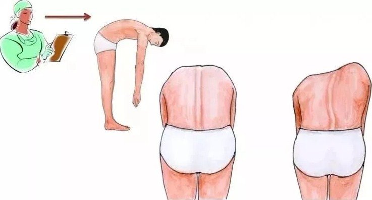 脊柱側(cè)彎早發(fā)現(xiàn)，早治療