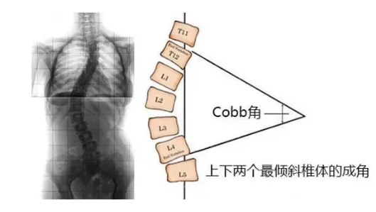 脊柱側(cè)彎角度怎么測(cè)量？